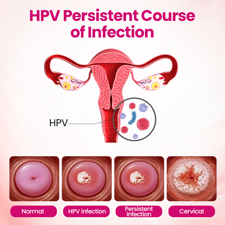 Timilk® IntiDefend Anti-HPV Interferon Gel✅ Blocks High-Risk HPV · Repairs Cervical Tissue · Supports HPV-Negative Results