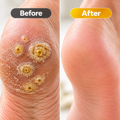 Biancat® BeeClear Wart & Corn Renewal Cream