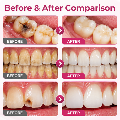 Timilk® DenPerm Cavity-Repair Natural Enamel Filling Gel