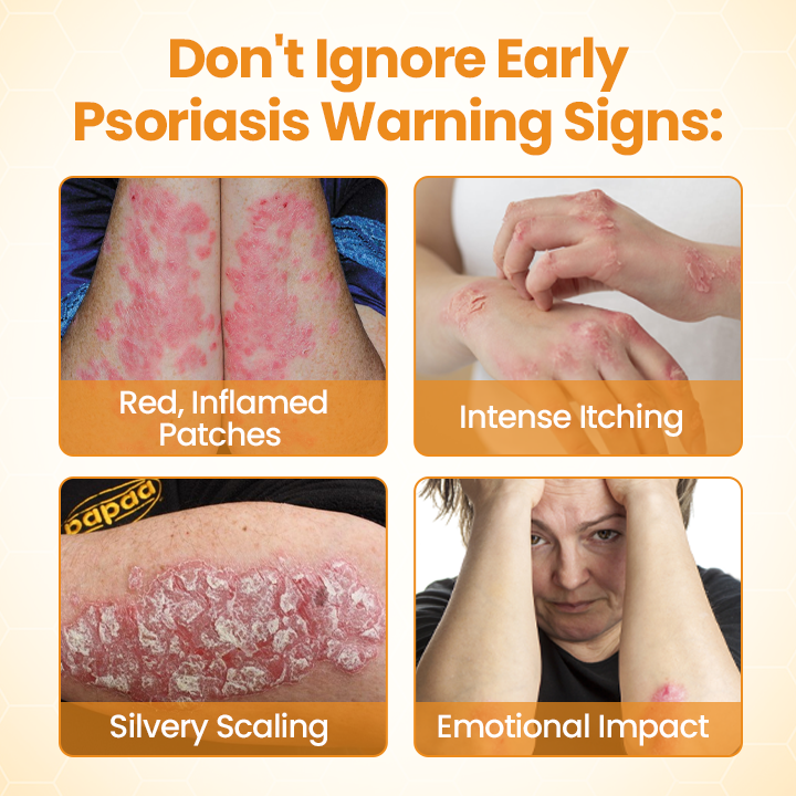 Timilk®BeeLieve Psoriasis Skin Care