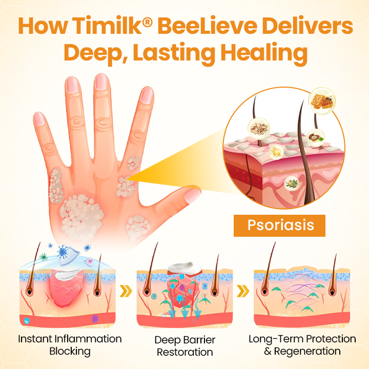 Timilk®BeeLieve Psoriasis Skin Care