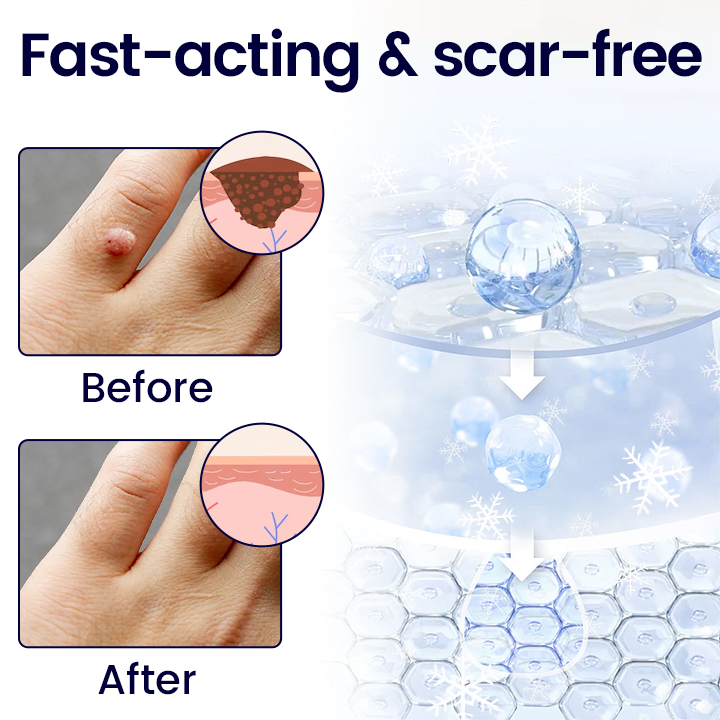 Timilk® WartErase Cryo Freeze Spray -