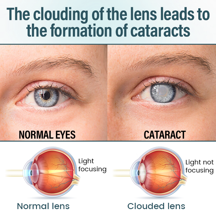 Timilk® OptiFusion Nano Eye Drops Serum—Nano Technology Restores Clear Vision,  No Glasses, No Surgery