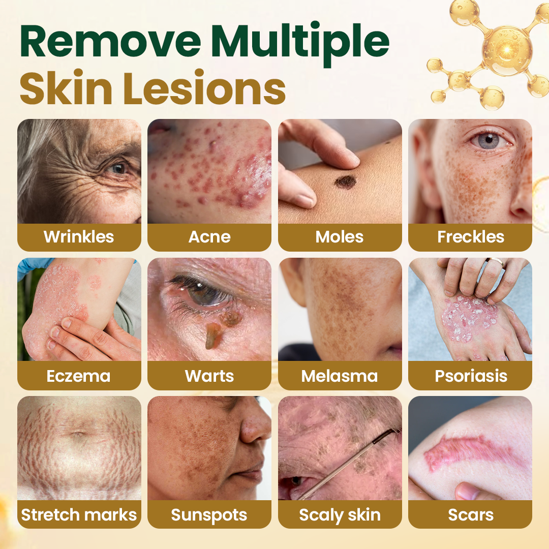 Timilk® Wart Remover Cream with Bee Venom and Salicylic Acid – Skin Tag Removal & Skin Repair Formula for Face and Body