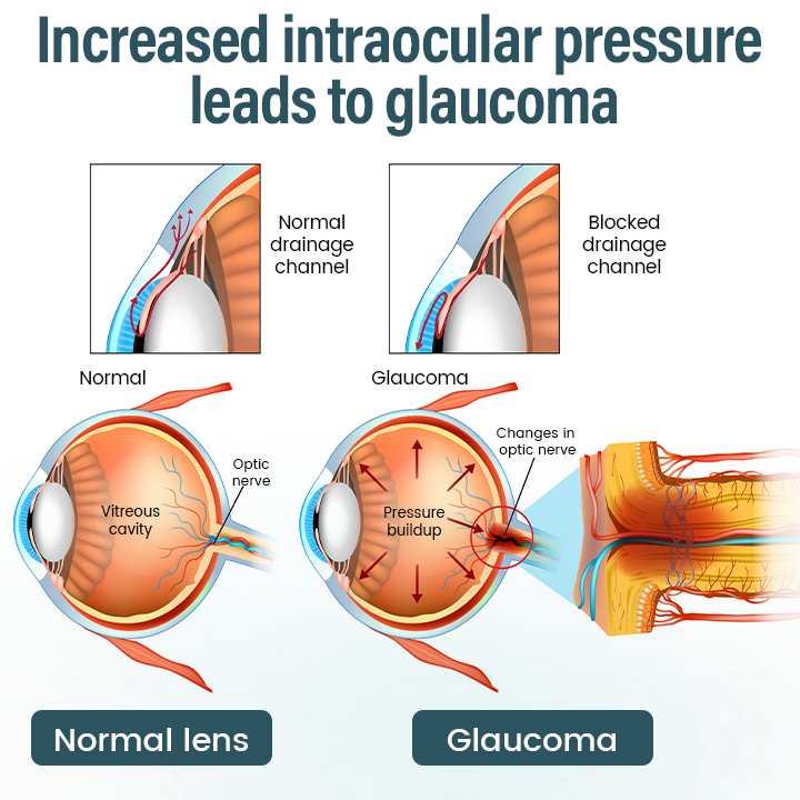 Timilk® OptiFusion Nano Eye Drops Serum—Nano Technology Restores Clear Vision,  No Glasses, No Surgery