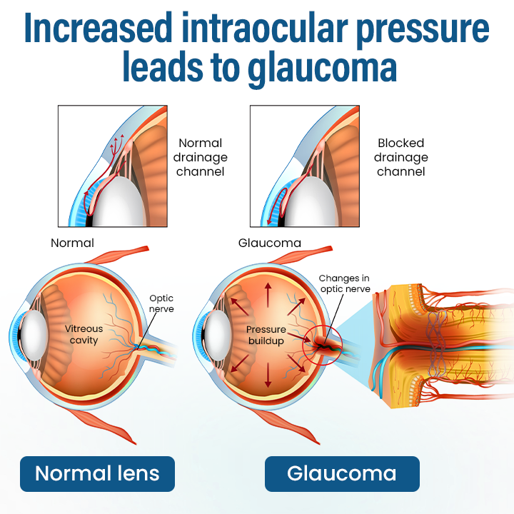 Timilk® VisionReborn Nano Eye Drops — 🌿Nano Actives,  Vision Without Surgery