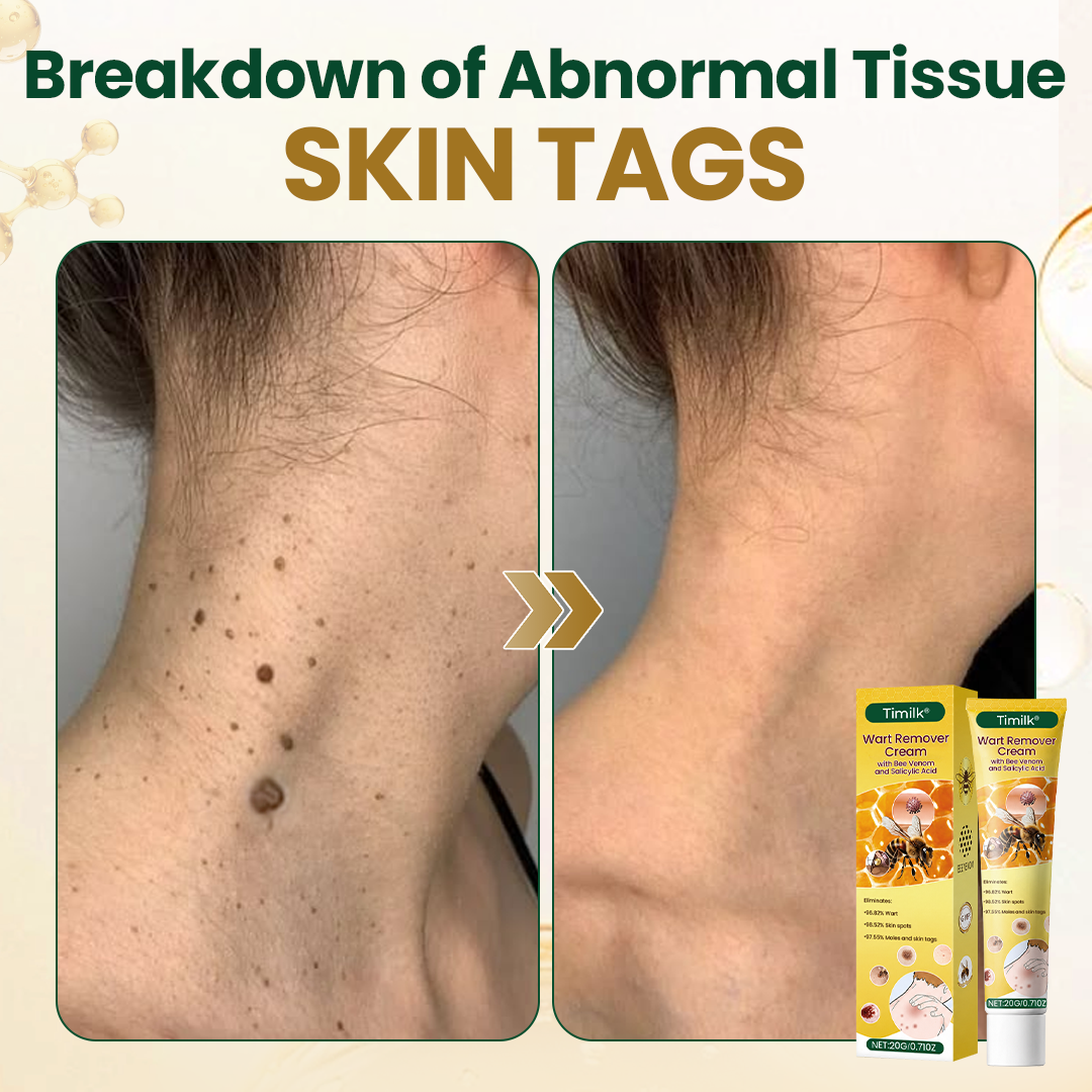 Timilk® Wart Remover Cream with Bee Venom and Salicylic Acid – Skin Tag Removal & Skin Repair Formula for Face and Body