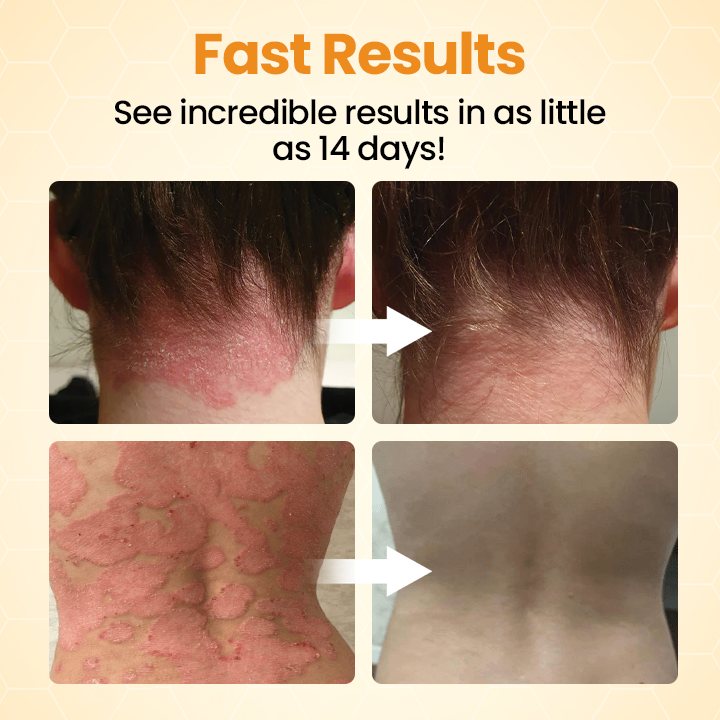 Timilk®BeeLieve Psoriasis Skin Care